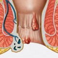 Anal Fissür ve Fistülleri Nelerdir ?
