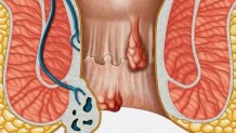 Anal Fissür ve Fistülleri Nelerdir ?
